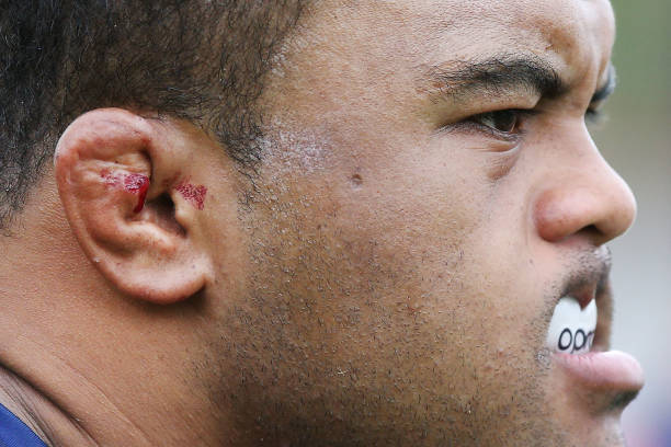 The bleeding cauliflower ears of Sam Talakai are seen during a Melbourne Rebels Super Rugby training session at Gosch's Paddo