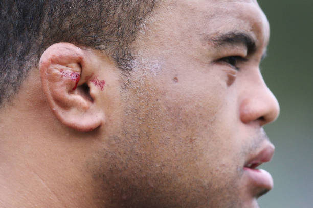 The bleeding cauliflower ears of Sam Talakai are seen during a Melbourne Rebels Super Rugby training session at Gosch's Paddo