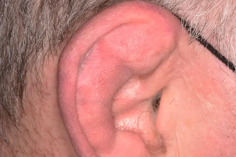 cauliflower ear wrestler