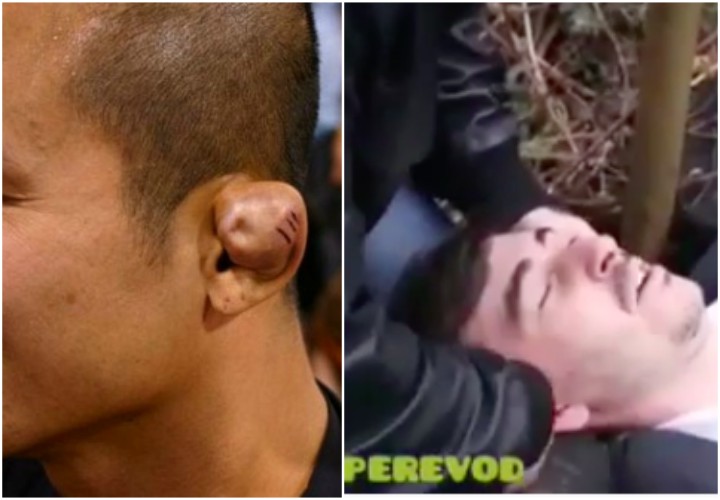 Madness: Grapplers Giving Themselves Cauliflower Ears To Look Tougher