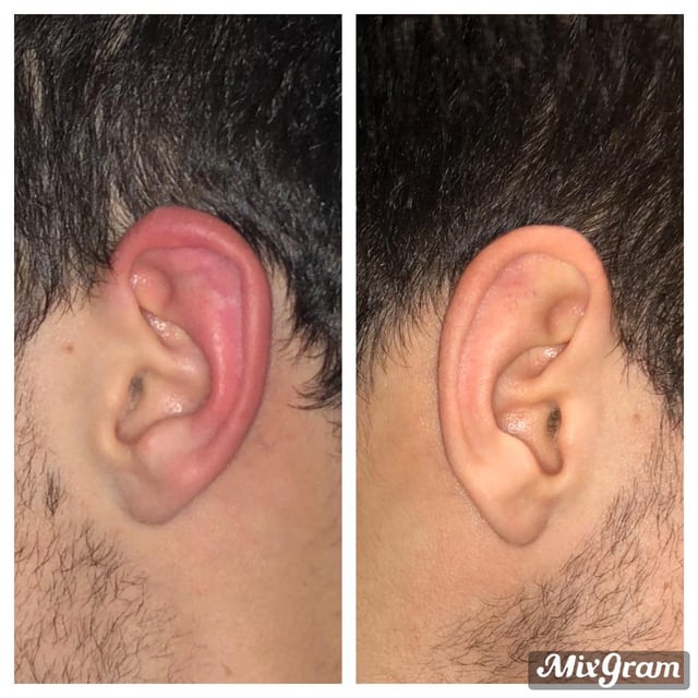 r/bjj - Cauliflower ear or just swollen?