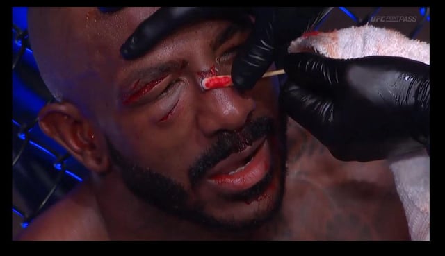 r/MMA - [SPOILER] Main card fighter's face is worse for wear, after the fight.