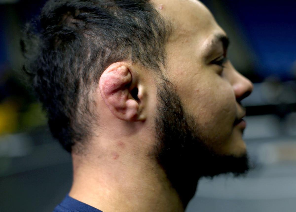 Cauliflower Ear In Wrestlers at Mark Villa blog