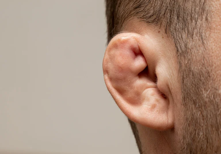 A close up of the side of a man's head, with obvious cauliflower ear.