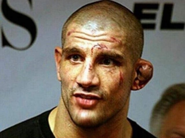 James Thompson Cauliflower Ear