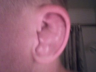 Real cauliflower ear deformity close-up from an untreated hematoma