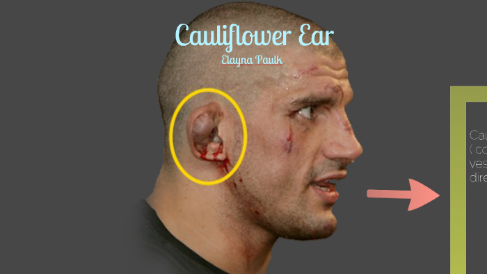 How To Make Cauliflower Ear Harden Faster